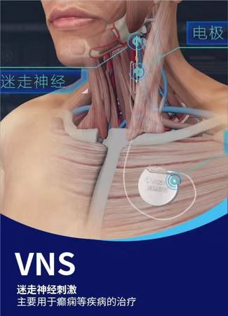 迷走神经刺激系统